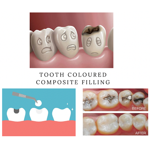 FILLINGS