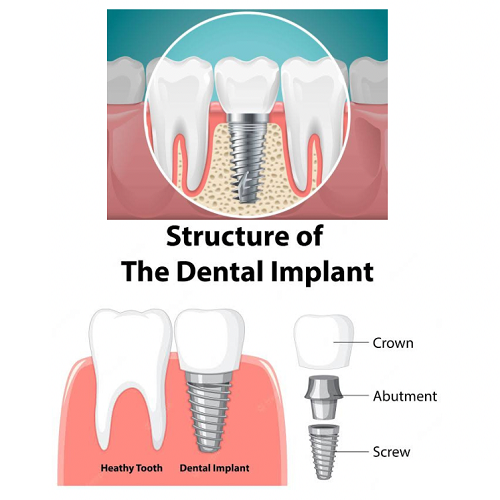 DENTAL IMPLANTS