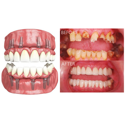 FULL MOUTH REHABILITATION
