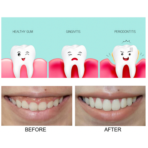 PERIODONTAL SURGERY