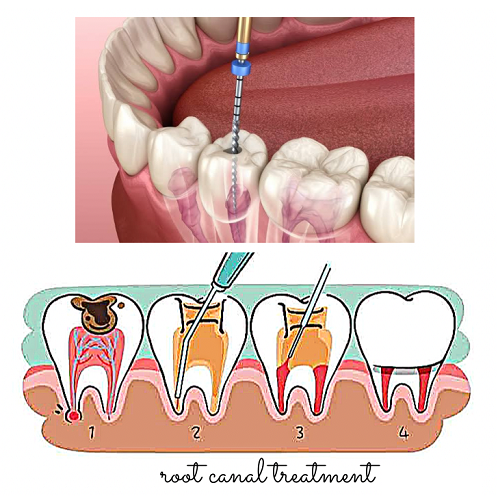 ROOT CANAL TREATMENT (RCT)