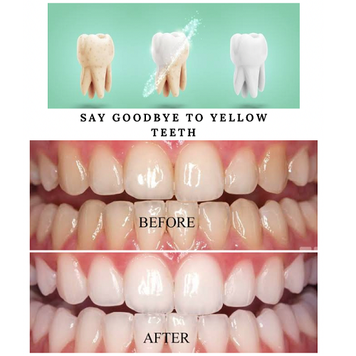 TEETH WHITENING